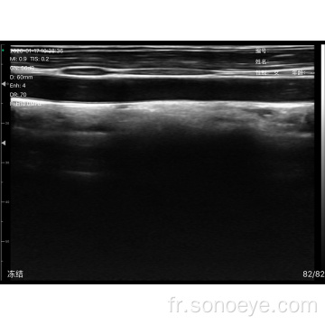 Scanner ultrasonore linéaire super largeur pour inspecter la poitrine